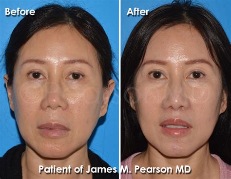 Lip Lift Photos - Before & After - Dr. James Pearson Facial Plastic Surgery