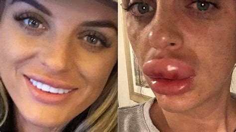 British woman almost loses lip at 'botox party' | Fox News Video