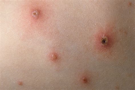 Chickenpox Picture (Hardin MD Super Site Sample)