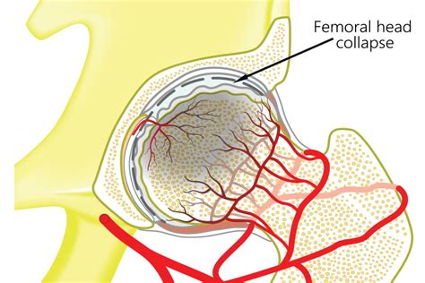 Avascular necrosis of the hip | Naples' best orthopaedic surgeon