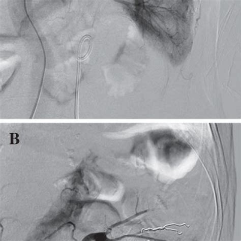 Selective renal angiography. Selective renal angiography revealed renal... | Download Scientific ...