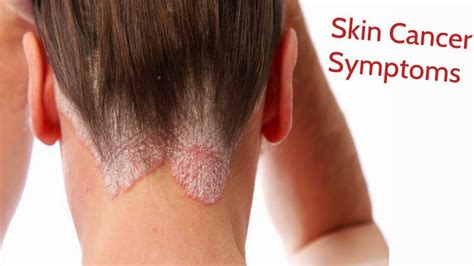 Wellness Lab Health Info: Skin Cancer Sign and Symptoms