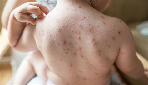 Chickenpox: Causes, Symptoms, Treatment & Prevention