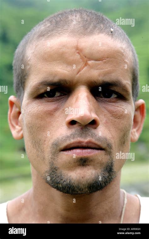 "Nepalese man with a huge scar Stock Photo - Alamy