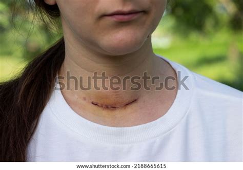 57 Scars On Woman Neck Thyroid Images, Stock Photos & Vectors ...