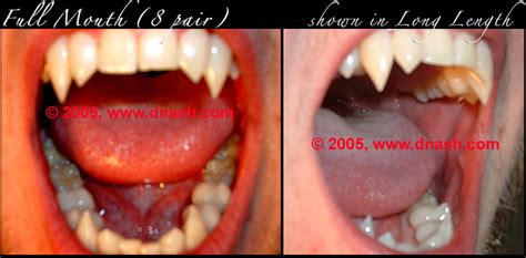 Custom Dental Fangs - Dental News Network