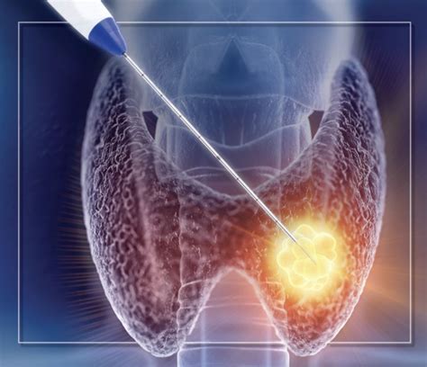 Radiofrequency Ablation of Thyroid Nodules - Atlanta's Advanced Thyroid ...