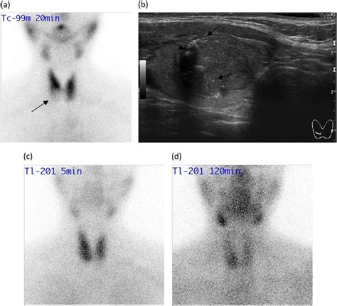 a A Tc-99m scintigraphy image showing a cold thyroid nodule (arrow) in... | Download Scientific ...