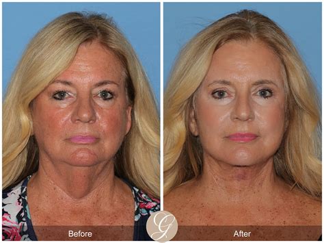 Before & After Face Procedures in Newport Beach CA | Orange County Facial Plastic Surgeon