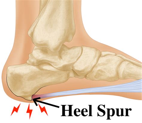 Bone spurs of the heel of foot defined and treatments