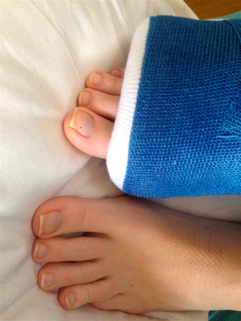 10 Months + Peroneal Tendon Surgery Update - Treading Lightly