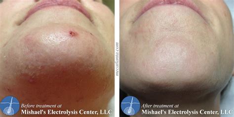 Before & After Electrolysis Hair Removal | Mishael's Electrolysis Center