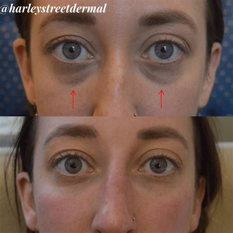 Dark Circles Treatment in London | Harley Street Dermal