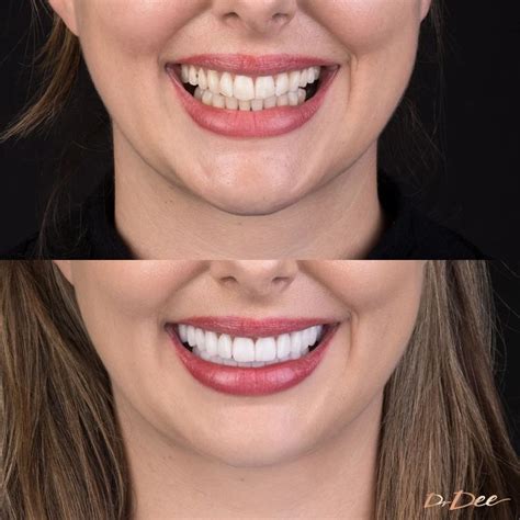 Our results gallery shows before and after images for treatments such as porcelain veneers ...