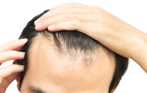 Receding hairline: Treatment, stages, and causes