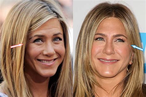 Jennifer Aniston Fillers