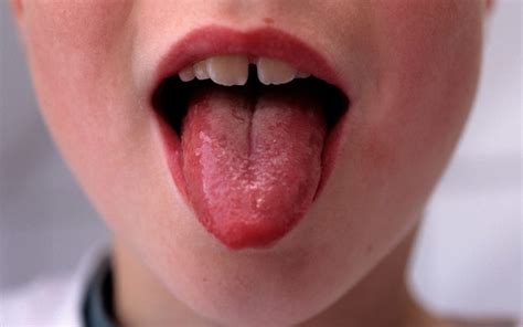 Strep A: What are the symptoms and how infectious is it?