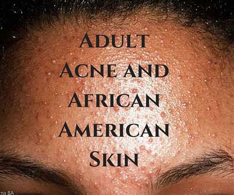 Acne is a major source of embarrassment for people of all ages and backgrounds. It causes ...