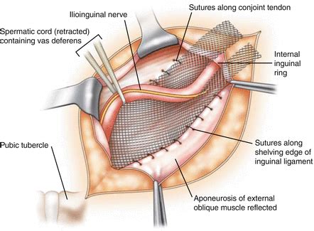 Inguinal Hernia Repair – GBMC Jordan