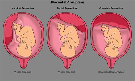 Abruptio Placentae Classification