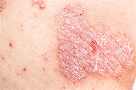 Genital psoriasis: Symptoms, treatment, and causes