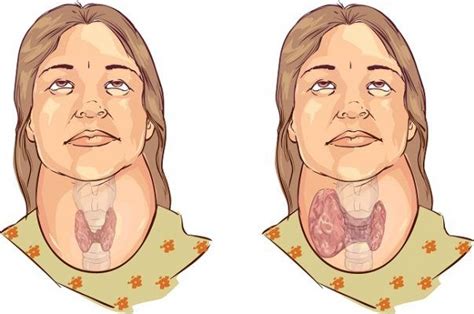 Qué es el bocio, sus causas, factores de riesgo y tratamientos naturales (con imágenes ...