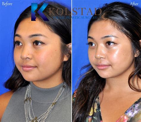 Filipino Nose Job Before And After