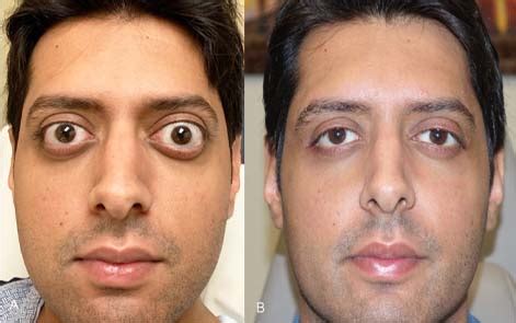 Thyroid Eye Disease Surgery - Thyroid Eyes Treatment