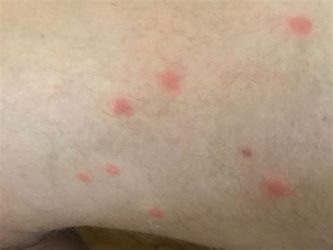 Swimmers itch cause - apgor