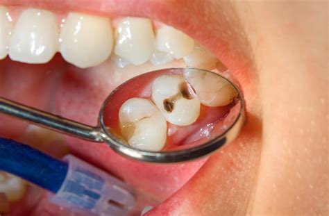 How Do Dentists Fix Cavities?｜Oakville