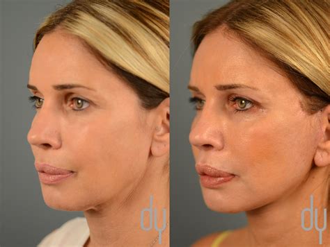 Facelift Before and After | Deep Plane Facelift Recovery | Beverly Hills Facial Plastic Surgery ...