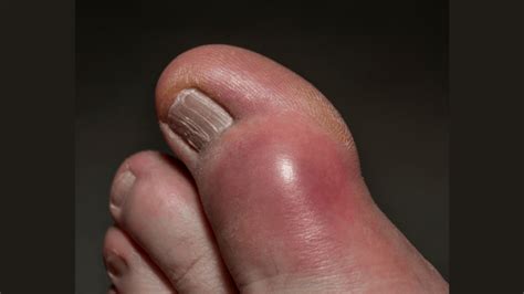 9 Pictures of the Gout: Symptoms, Food to avoid, other tips : Physiosunit