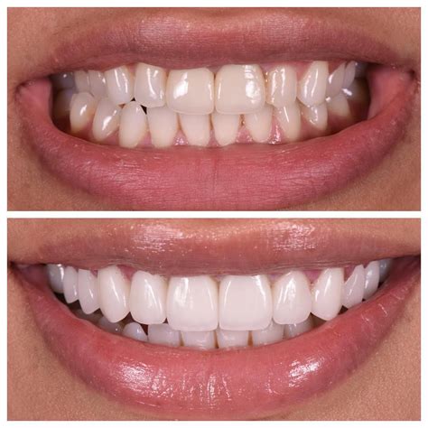 Veneers For Teeth Procedure at Alma Hale blog