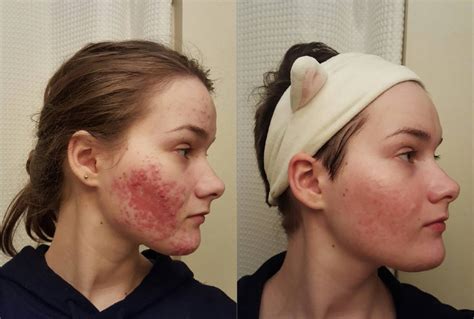 acne before and after reddit