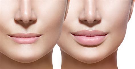 5 Major Lip Filler Benefits & What To Expect