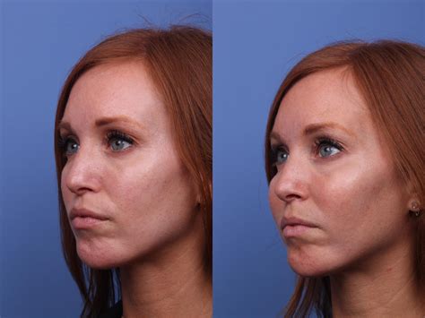 Cheek Implant Before and After Pictures Case 317 | Scottsdale & Phoenix, AZ | Hobgood Facial ...