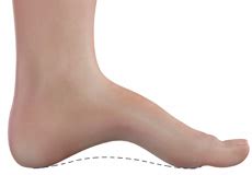 Cavovarus Foot Correction Charleston, SC | Cavovarus Foot Deformity Charleston, SC