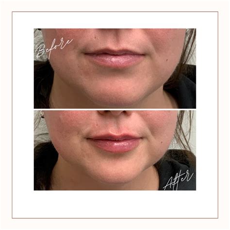 Lip Injections - Lip Fillers - Reduce signs of Aging