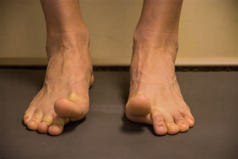 Injury-proof your feet with th - Grey Rolfe Bezuidenhoudt Physiotherapists