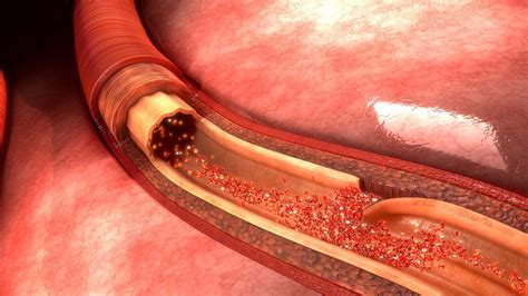 Carotid Artery Surgery - Pensler Vein Institute - Ferndale, MI.