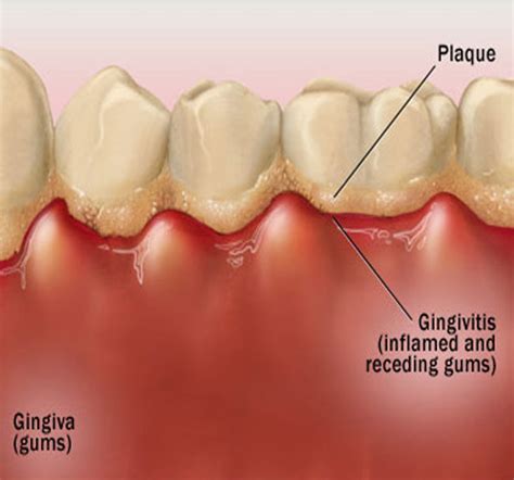 Dentist West Palm Beach FL: Treating Gingivitis