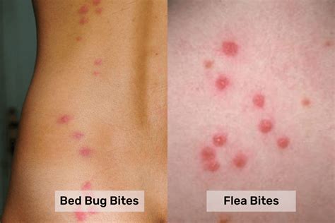 Bed bugs bite vs. Flea Bite: What's the Difference? - Pest Control Gurus