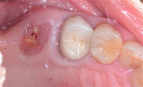 Pictures of Granulation Tissue After Tooth Extraction: Pictures and What to Do - Go Fix Teeth