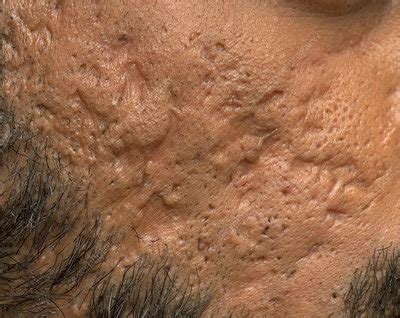 Scarring from cystic acne - Stock Image - C050/1008 - Science Photo Library