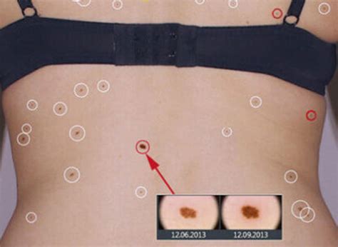 What is mole mapping and why is it important for your health? - Skin Cancer Clinic Melbourne