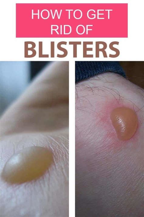 How to Get Rid of Blisters Fast? Home Remedies For Blisters