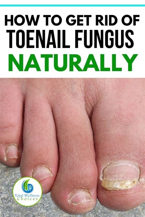 9 Best Natural Home Remedies for Toenail Fungus | Toenail fungus ...