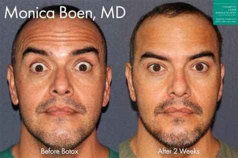 Most Common Side Effects of Botox - Cosmetic Laser Dermatology Skin Specialists in San Diego