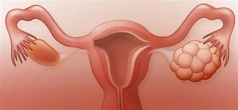 Ovarian Retention Cyst: Symptoms, Treatment, Photo | Health Articles 2024