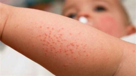 Heat Rash Causes Symptoms Treatments Heat Rash Heat Rash Causes - Riset